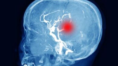 Photo of ब्रेन इंजरी के बाद ‘साइलेंट किलर’ बन सकता है हाइड्रोसिफलस